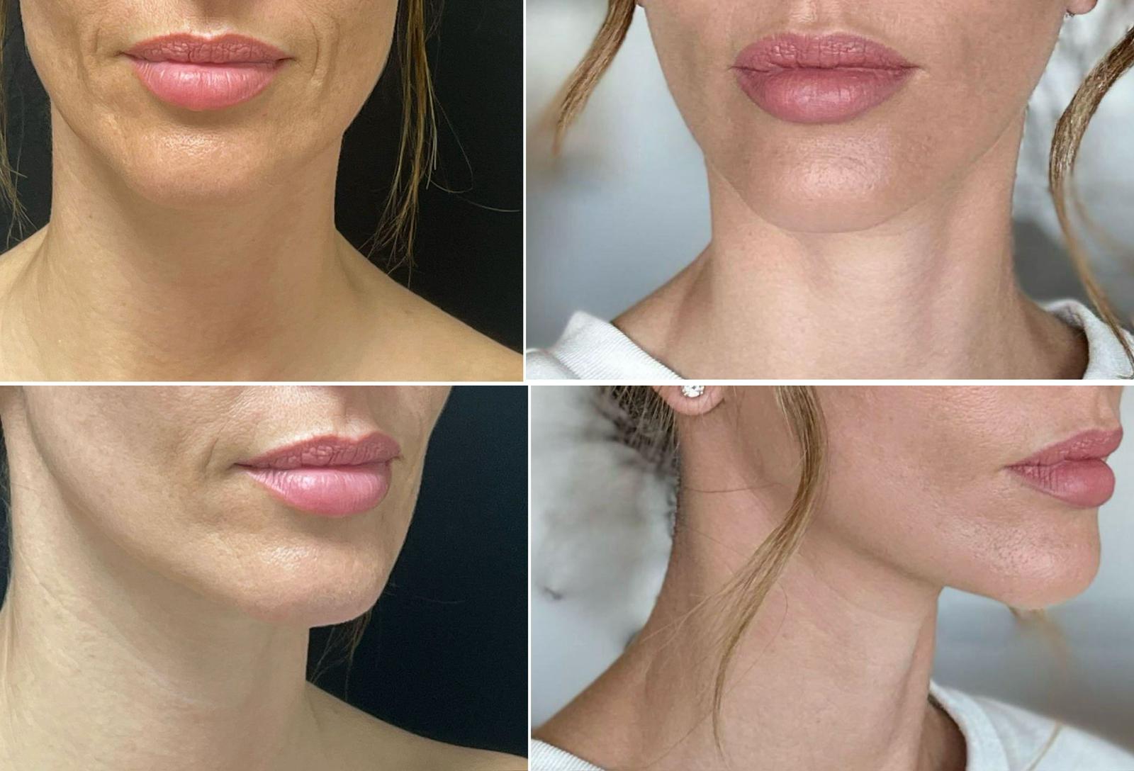 Dr. Kusuma facelift reviews Weston - FL