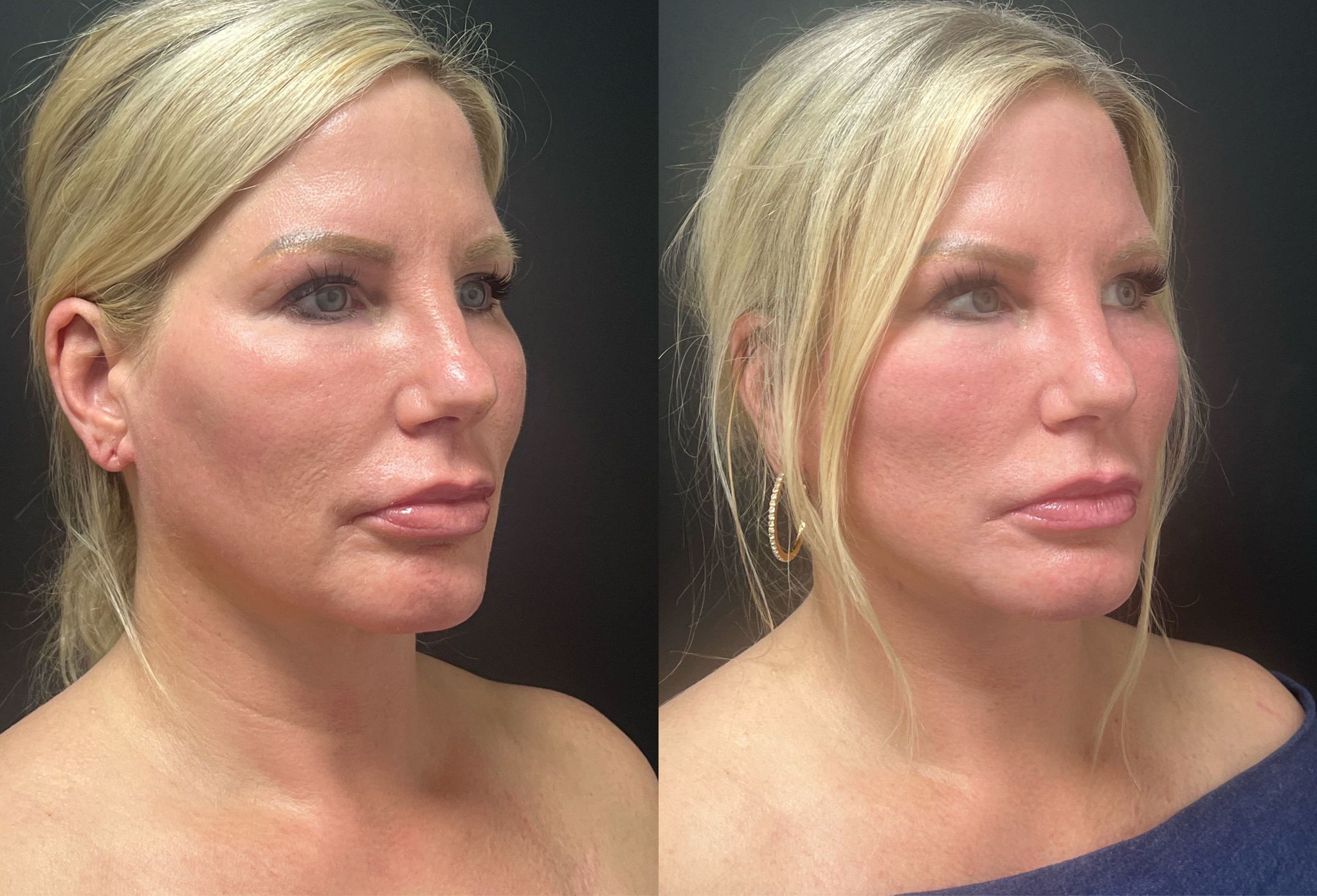 Dr. Kusuma facelift reviews Weston - FL